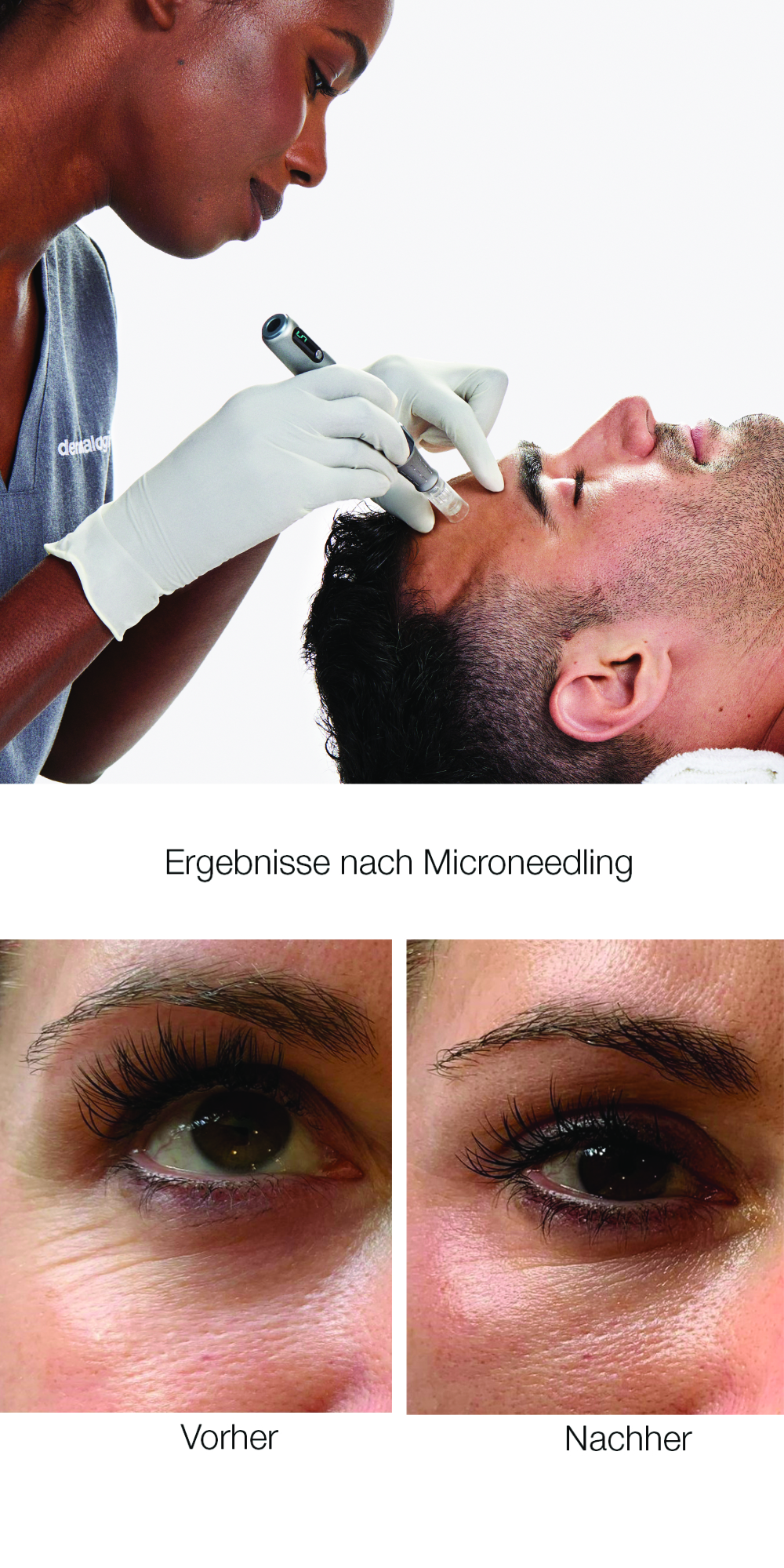 Micro needling